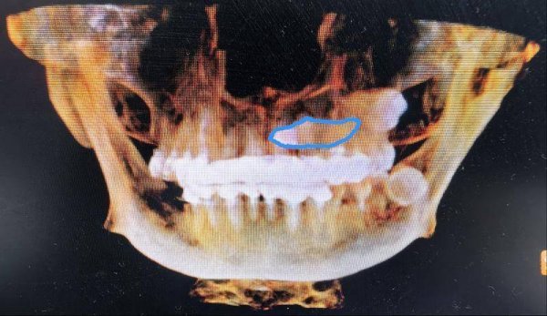 股票申请配资 微创巧解埋伏牙 贵阳市口腔医院帮扶医生护安康